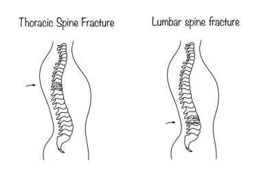Bel omurgasında kırık ve göğüs omurunda kırık var. Göğüs ve bel bölgesindeki omurga bütünlüğünün bozulması. Bir insanın sırt yaralanmasının görsel bir çizimi. Siyah ve beyaz vektör. 
