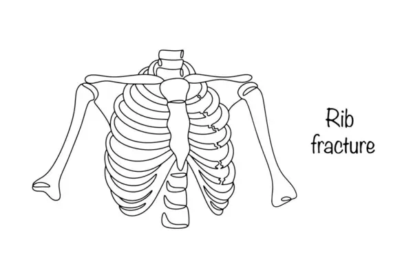 stock vector Rib fracture. Traumatic damage to the integrity of the rib bones in several places. Vector illustration.