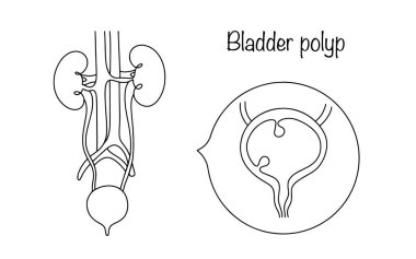 Mesane polipsi. Mesanenin mukoza zarının yüzeyinde iyi huylu bir oluşum meydana gelir. İnsan dışkılama sisteminde bir hastalık. Vektör illüstrasyonu.