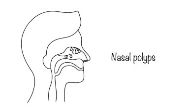 Burun polipsi. Burun ve sinüslerdeki mukoza zarının iyi huylu bir şekilde büyümesi burundan nefes almasını engelliyor. Tıbbi alanda kullanılmak üzere illüstrasyon.
