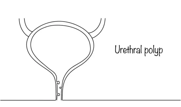 stock vector Hand-drawn urethral polyps as benign growths of the urethra. Medical vector for different uses. Urinary tract disease.