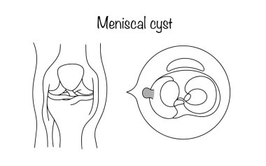 Meniskal kist. Diz eklemi boşluğunda mukus benzeri bir maddeye sahip bir kapsül. Diz eklemi yaralanması sonucu. Siyah ve beyaz vektör çizimi.