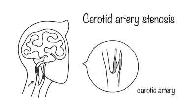 Karotid arter stenozu. Karotid arterin lümeninde patolojik daralma. Trombüs ya da aterosklerotik plakla şahdamarının tıkanması. Devam eden bir çizgi ile el çizimi illüstrasyon.