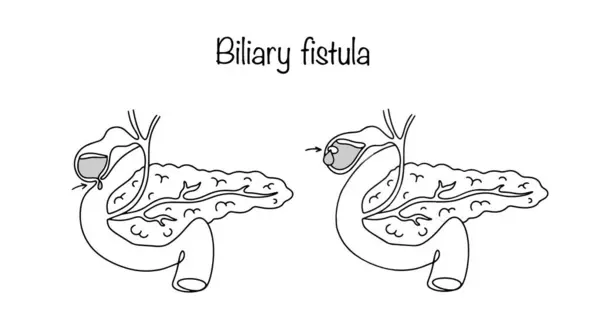 stock vector Pathological anastomosis formed between the gallbladder and the stomach and between the gallbladder and the anterior abdominal wall. Medical illustration for different uses.