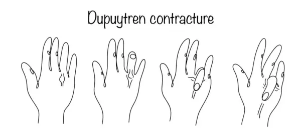 stock vector Dupuytren contracture. Deformation of the palmar tendons, which leads to the loss of the ability of the fingers to fully extend. Hand drawn progressive contracture. Vector illustration.