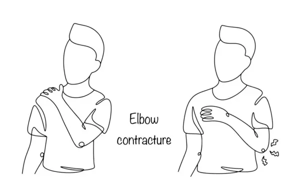 stock vector Elbow contracture. A man is drawn who can freely bend his arm at the elbow and a man with limited mobility of the elbow joint. Vector illustration.