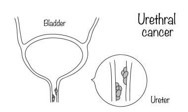 Urethral kanser. Üretranın dokularında gelişen en en nadir oncourolojik hastalıklar. Tıbbi konulardaki görsel illüstrasyon. Vektör illüstrasyonu.