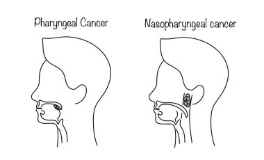 Gırtlak kanseri ve nazofaringeal kanser. Epitel hücrelerden kaynaklanan habis neoplazma. Tıbbi vektör illüstrasyonu.