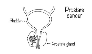 Prostat kanseri. Prostatın glandüler epitelyumunun hücrelerinin dönüşümü sonucu oluşan habis bir neoplazma. Erkek kanseri. Tıbbi vektör.