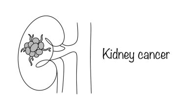 Böbrek kanseri. Böbrek dokusunda kötü huylu dejenerasyonun meydana geldiği onkolojik bir hastalık. Beyaz arka planda kanserli bir tümör olan böbrek. Vektör illüstrasyonu.