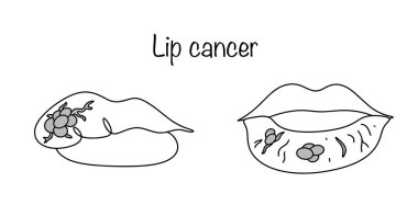 Dudak kanseri. Dudakların kırmızı kenarındaki entegumsal epitelyumun kötü huylu tümörü. Şiddetli, ilerici kanser. Vektör.