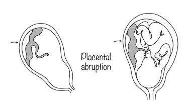 Pathology when placental tissue separates from the wall of the uterus during gestation. Medical illustration on the topic of gynecology and obstetrics. Isolated vector. clipart