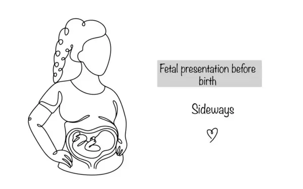 stock vector Pregnant woman with transverse presentation of the fetus. Incorrect placement of the fetus in the uterus. Medical vector illustration for different uses. 