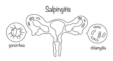 Dölyatağı borusunda enfeksiyondan kaynaklanan iltihaplı hasar. Salpinjit ve bu hastalığın ana nedensel etkenleri. Beyaz arkaplanda izole edilmiş vektör.