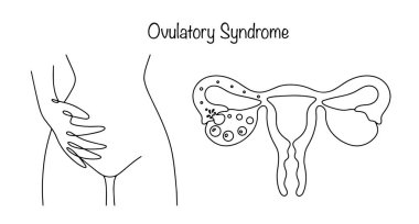Yumurtalık Sendromu. Yumurtlama sırasında bir kadın acı çeker. Tek taraflı acı. Yumurtalıktan yumurtayı bırak. Farklı kullanımlar için tıbbi vektör.