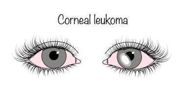 Corneal leukoma. An ophthalmological disease characterized by the formation of a white spot on the eye. A healthy eye and an eye with a cataract.  clipart