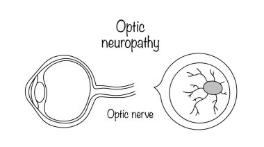 Sinir liflerinin yavaş ve sistematik ölümü ardından bağ dokusunun değiştirilmesi. Optik atrofiyle göz çizilmiş. Devam eden bir çizgiyle basit tıbbi illüstrasyon.