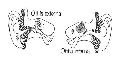 İltihaplı kulak hastalığı. Kulak kanalının derisinde akut enfeksiyon ve iç kulakta iltihaplanma. Beyaz arka planda izole edilmiş tıbbi vektör.