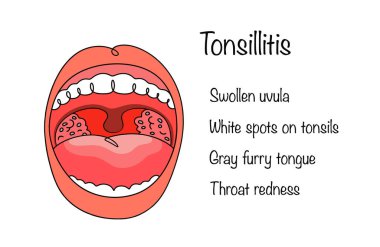 Bulaşıcı ve iltihaplı bir hastalık. Damak gevşetici bademcikleri iltihaplanıyor. Bademcik iltihabından muzdarip birinin ağzı ve hastalığın ana belirtileri. Vektör illüstrasyonu.