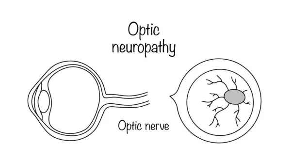 stock vector Slow and systematic death of nerve fibers followed by replacement by connective tissue. Drawn eye with optic atrophy. Simple medical illustration with a continuing line.