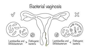 An infectious pathology in which the microflora in the vagina is disrupted. Imbalance between beneficial microflora and opportunistic microflora. Drawn balance and imbalance of microflora.