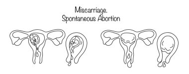 Kendiliğinden yapılan kürtaj işlemleri. Fetüs kesesinin rahim içinden doğal doğum kanalından çıkarılması. Jinekoloji konusunda tıbbi illüstrasyon. Vektör illüstrasyonu.