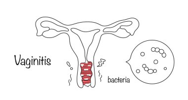 Vajinal mukozanın iltihaplı hastalığı, kaşıntı, acı ve patolojik boşalma ile birlikte. Vajinaların ve neden olduğu bakterilerin belirtileri. Vektör.