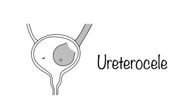 Cystocele disease. A condition in which the intravesical part of the ureter is cyst-like dilated. Vector illustration on a medical theme. clipart