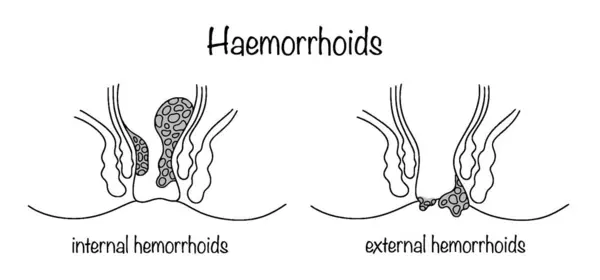 Stock vector Internal hemorrhoids and external hemorrhoids. Varicose veins of the rectum. Pathology of the rectum. Medical vector illustration on proctology theme.