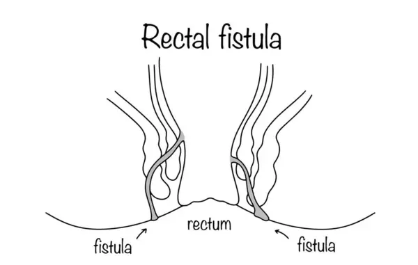 stock vector A pathological canal that forms in the soft tissues of the perianal area. Hand-drawn rectal fistula. Medical illustration for different uses.