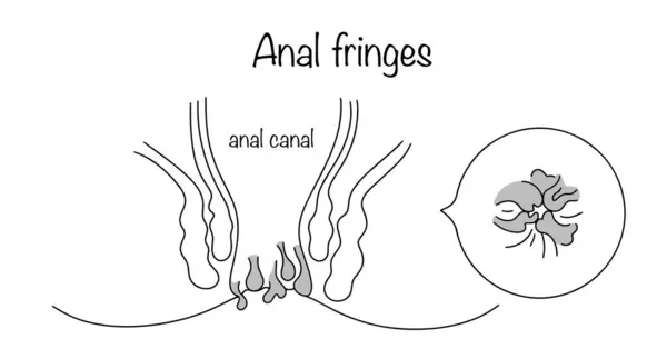 stock vector Anal fringes. Benign neoplasms near the anus. Skin growths located around the anus. Hand drawn medical illustration.