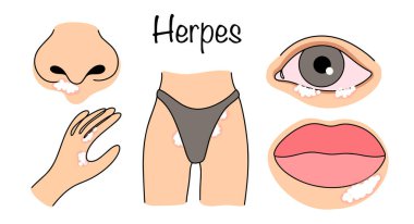 Göz, burun ve ağız zarlarında, genital bölgede ve ellerde uçuk döküntüleri var. Yaygın bir viral hastalık. Basit renk vektörü çizimi.