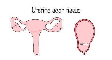 Scar outside and inside the uterus after a cesarean section. An altered section of the uterine wall, formed after it was damaged during surgery. Medical vector illustration. clipart