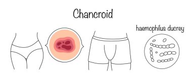 Chancroid. Yayılmaya ve çoğalmaya meyilli, enfeksiyon kaynaklı derin bir ülser. Elle çizilmiş zührevi hastalık. Tıbbi vektör illüstrasyonu.