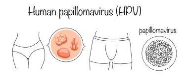 İnsan papilloma virüsü. Genel genital bölge enfeksiyonu. Çoğunlukla cinsel yolla bulaşan bir enfeksiyon deriyi ve mukoza zarlarını etkiliyor. Beyaz arkaplanda tıbbi vektör.