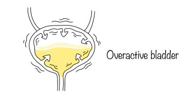 Bladder hyperactivity. Bladder dysfunction, in which the bladder muscle involuntarily contracts and leads to a strong urge to urinate. Medical color vector illustration. clipart