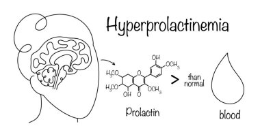 A disease in which the level of the hormone prolactin in the blood is significantly higher than normal values. The pituitary gland produces prolactin, which enters the blood. Simple illustration. clipart