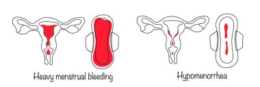 Menorajerlik. Düzenli olarak kan kaybıyla regl. Hipomenoroz. Çok az kan kaybetmiş bir adet. Kadın döngüsünün düzensizliği. Beyaz arkaplanda izole edilmiş vektör.