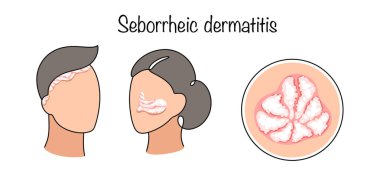 Dermatolojik iltihaplanma hastalığı. Deride pulların oluşumuyla birlikte. Deri iltihabı belirtileri olan kadın ve erkek. Vektör illüstrasyonu.