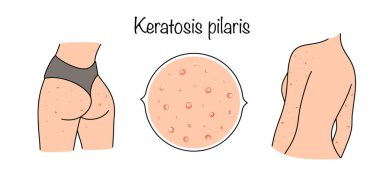 Nadir görülen kronik bir hastalık. Gövdenin derisinde, uzuvlarında ve özellikle avuç içi ve taban derilerinde sarımsı hiperkeratotik bölgelerin oluşumuyla birlikte. Vektör illüstrasyonu.