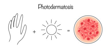 Derinin güneş ışığına olan hassasiyetinin artmasından kaynaklanan iltihaplanmayan bir cilt süreci. Ultraviyole radyasyona cilt reaksiyonu. Renkli tıbbi vektör çizimi.