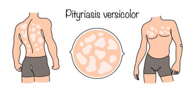 Pityriasis versicolor. Deride renkli kızarıklıklara neden olan bir mantar enfeksiyonu. Vücudunda hastalığın belirtileri olan bir adam. Dermatolojik hastalıkları tedavi edebilir. Vektör illüstrasyonu.