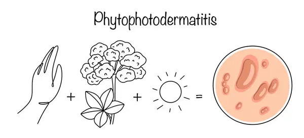 stock vector The reaction of the skin to contact with a certain plant and parallel exposure to solar radiation. Dermatology vector isolated on white background. Vector illustration.