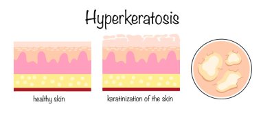 Hiperkeratoz. Hiperkeratozlu sağlıklı deri ve deri. Deride aşırı keratinizasyon. Dermatolojik hastalık. Farklı kullanımlar için izole edilmiş vektör.