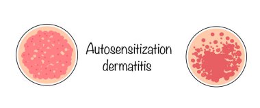 Otoosansitizasyon dermatiti. Deride iltihaplı lezyonların oluşumuyla ortaya çıkan alerjik bir deri hastalığı. Vektör illüstrasyonu.