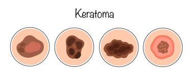 A benign skin neoplasm formed from the stratum corneum of the epidermis. Hand-drawn main types of keratoma. Color vector illustration on the theme of skin diseases. clipart