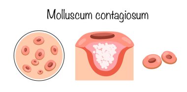 Molluscum contagiosum. A skin disease caused by a viral infection. Manifestation of the disease on the skin in the form of a characteristic rash. Vector illustration. clipart