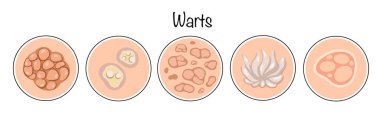 Warts. A benign skin neoplasm of viral etiology, having the appearance of a nodule or papilla. The main types of warts that are found on human skin. Vector illustration on the theme of skin diseases. clipart