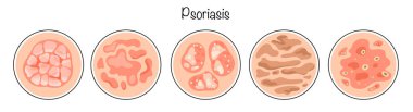 Sedef hastalığı. Bulaşıcı olmayan, iltihaplı dermatolojik bir hastalık. Sedef hastalığının ana türleri elle çizilmiş. Deri hastalığı. Renkli izole vektör.