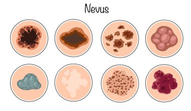 İyi huylu deri neoplazması pigmentli hücrelerden oluşur. İnsanların derilerinde farklı yaş grupları görülür. Dermatoloji ve kozmetik bilimi temasında renk vektörü çizimi.